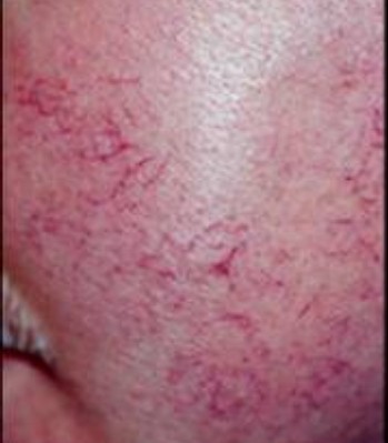 Telangiectasia before laser treatment