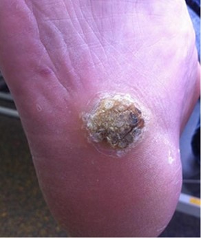 Verruca prior to Nd:YAG laser treatment