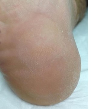 Resolved verruca post laser treatment.