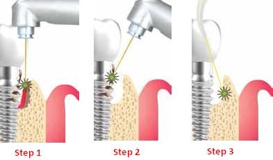 TwinLight Peri-implantitis treatment
