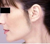 Hirsutism - male pattern of body hair on females