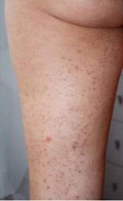 The infection and inflammation of one or more hair follicles