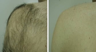 Effects of laser hair removal